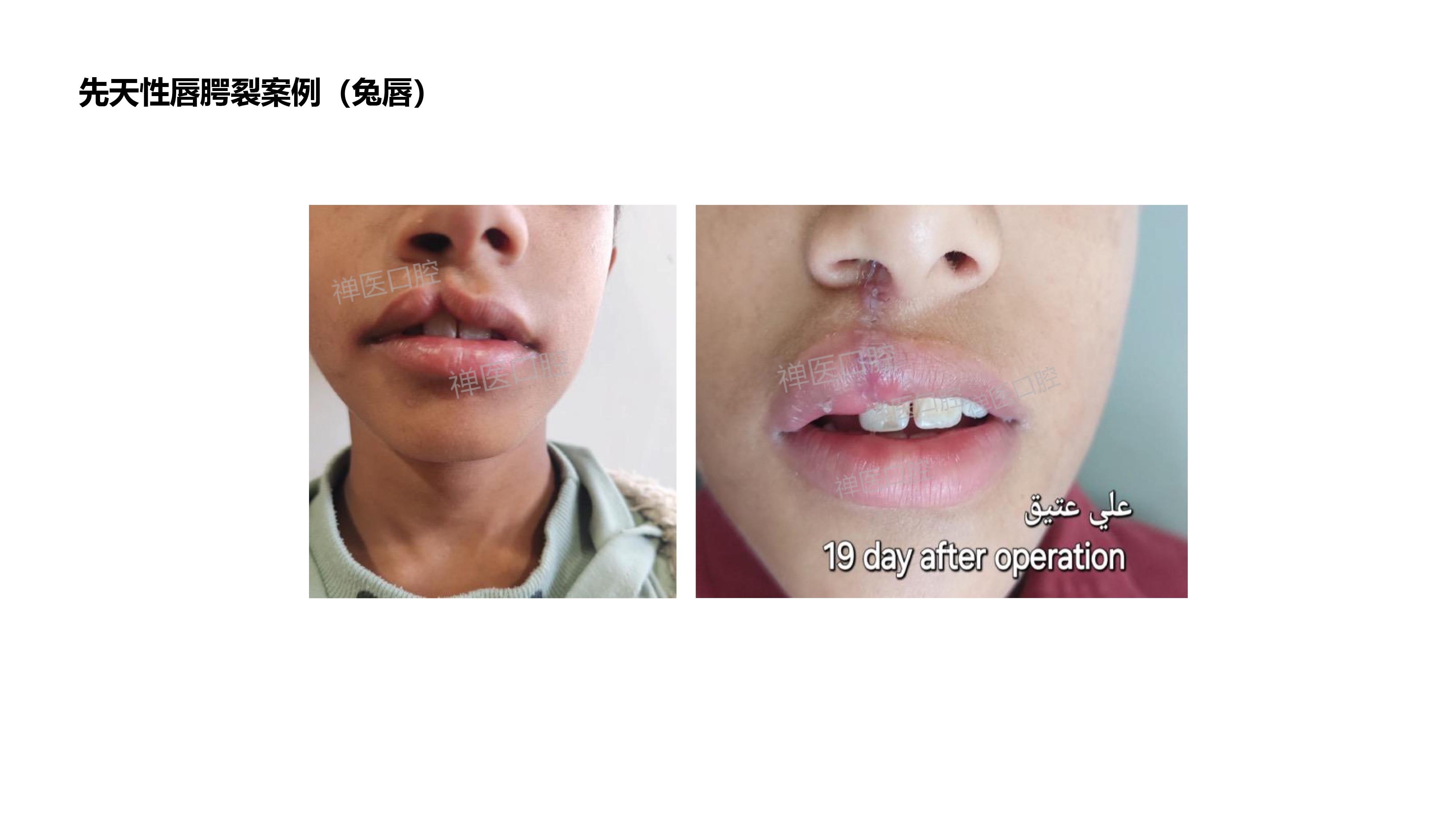 正颌术后