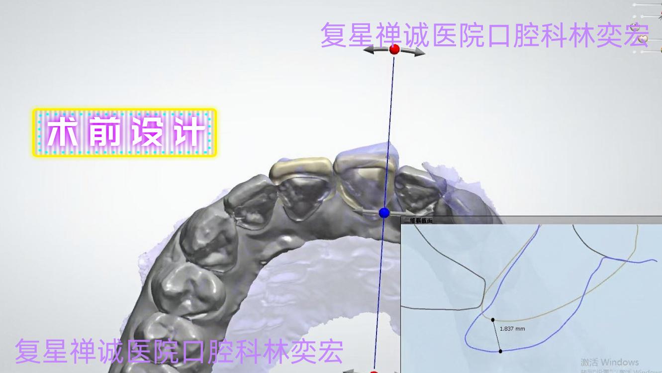 牙瘤术前