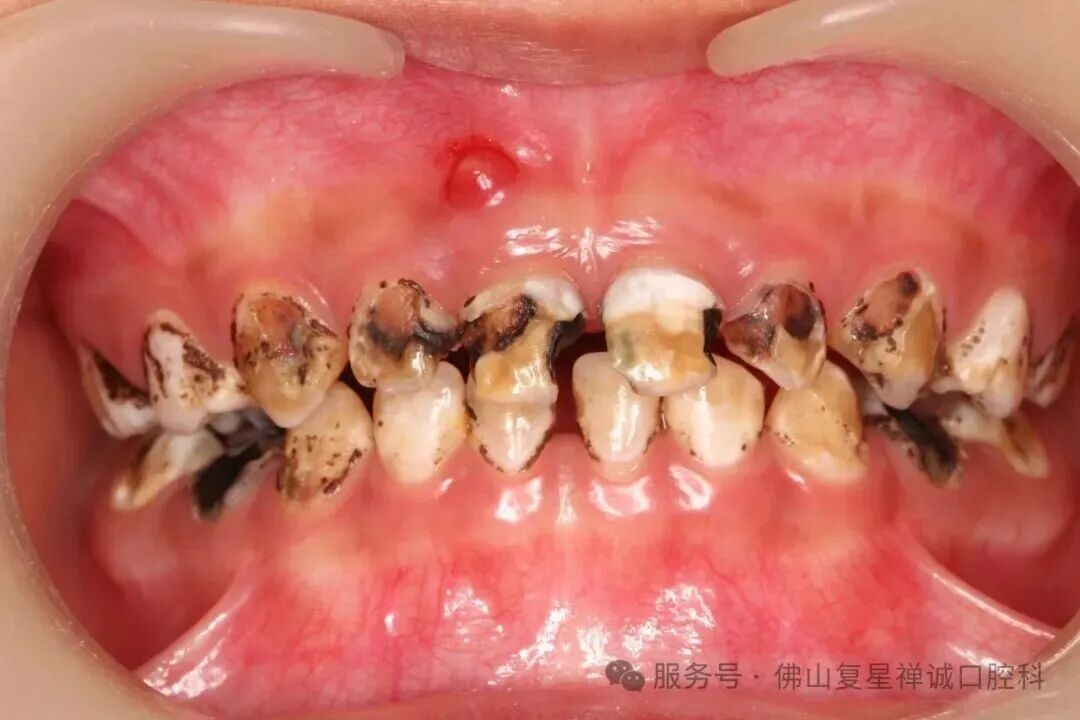 甜甜口腔检查情况