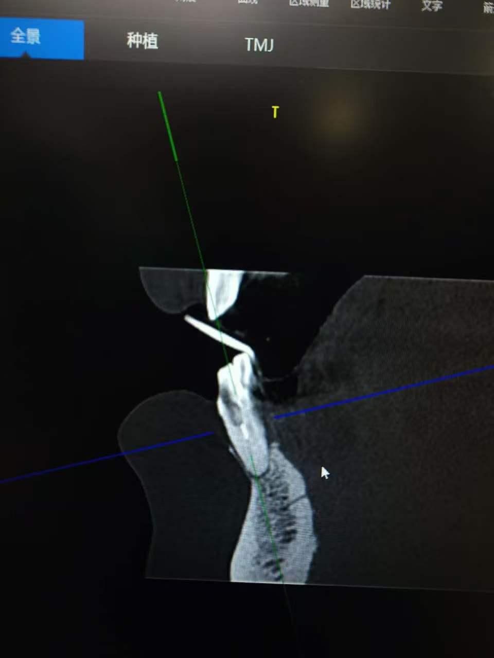 前牙美学修复