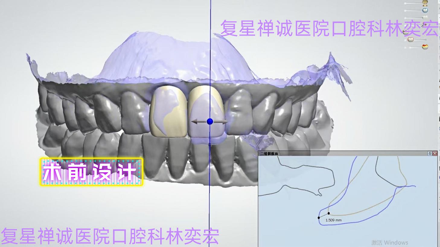 牙瘤术后