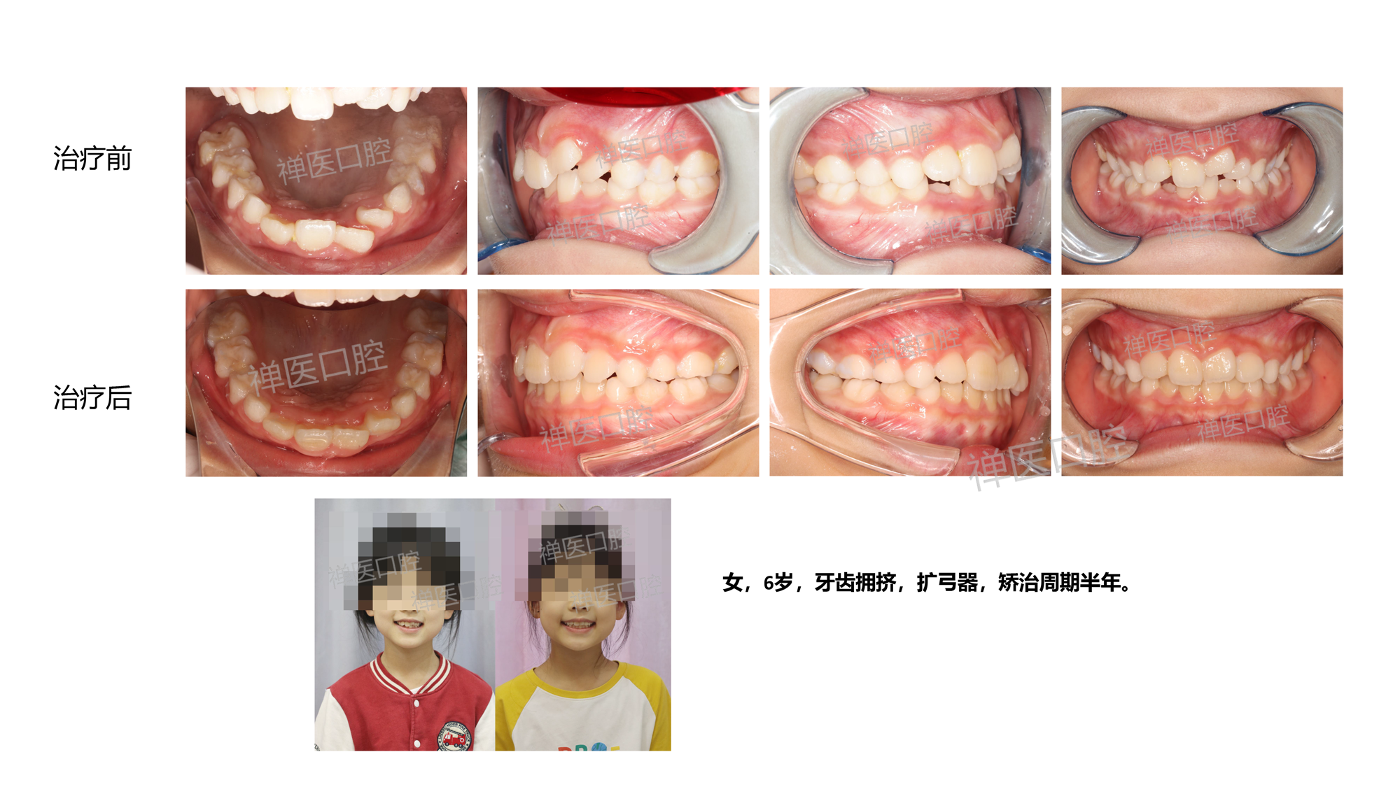 牵引后效果