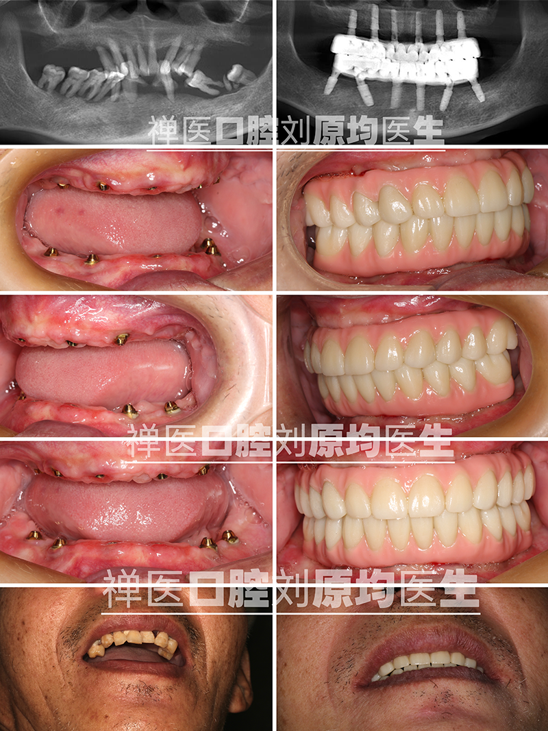 65岁患者