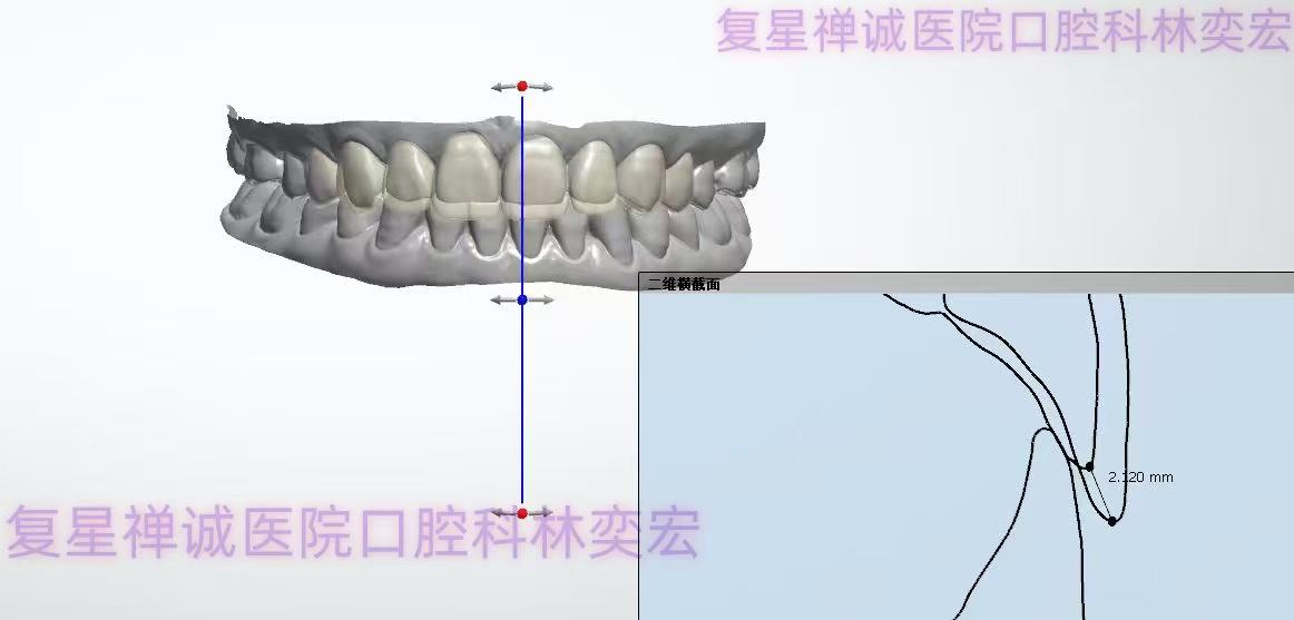 唇腭裂案例
