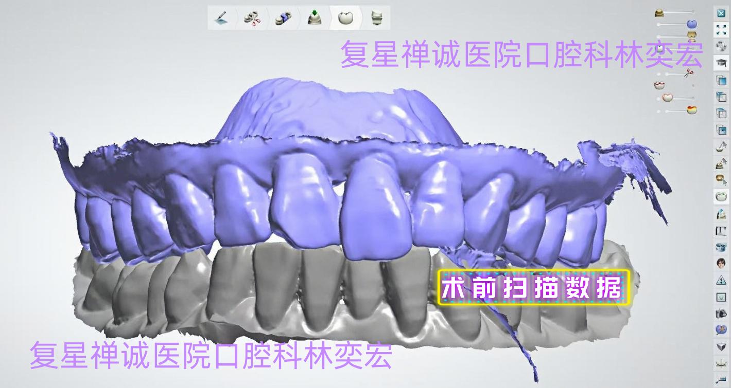 牙瘤案例