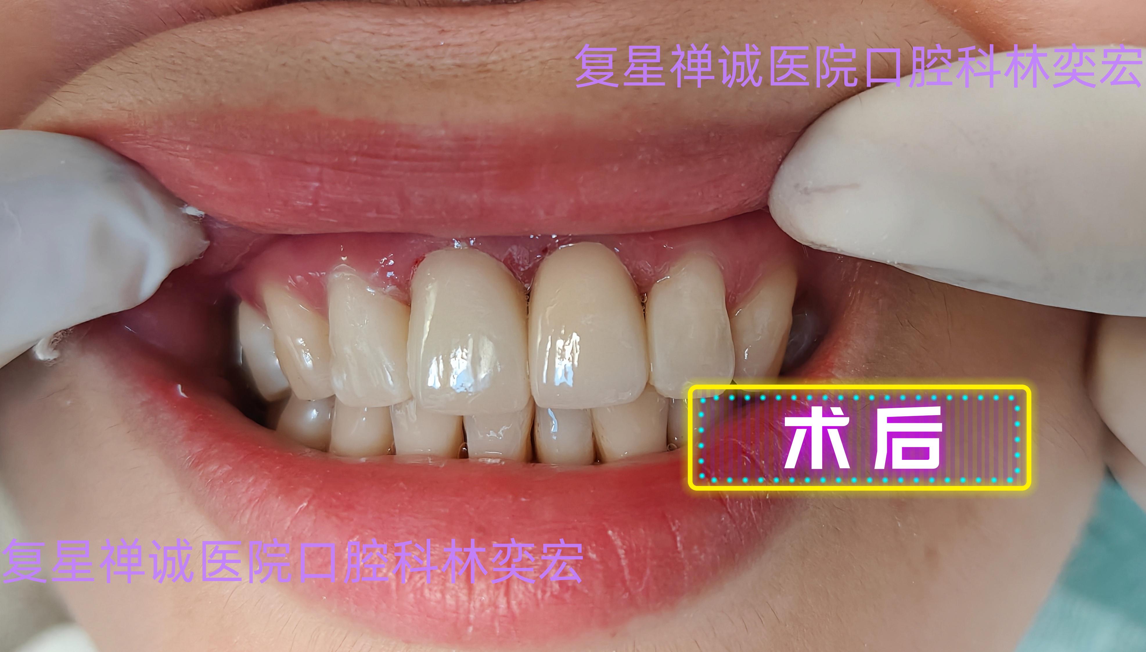 舌下导管结石术后